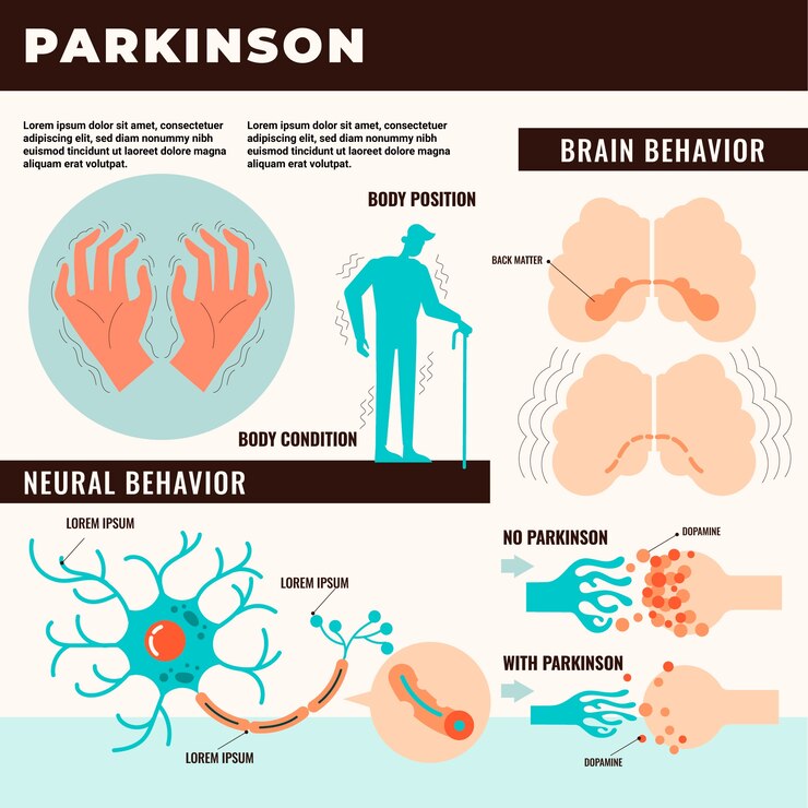CBD for Parkinson's Disease: Exploring Potential Benefits