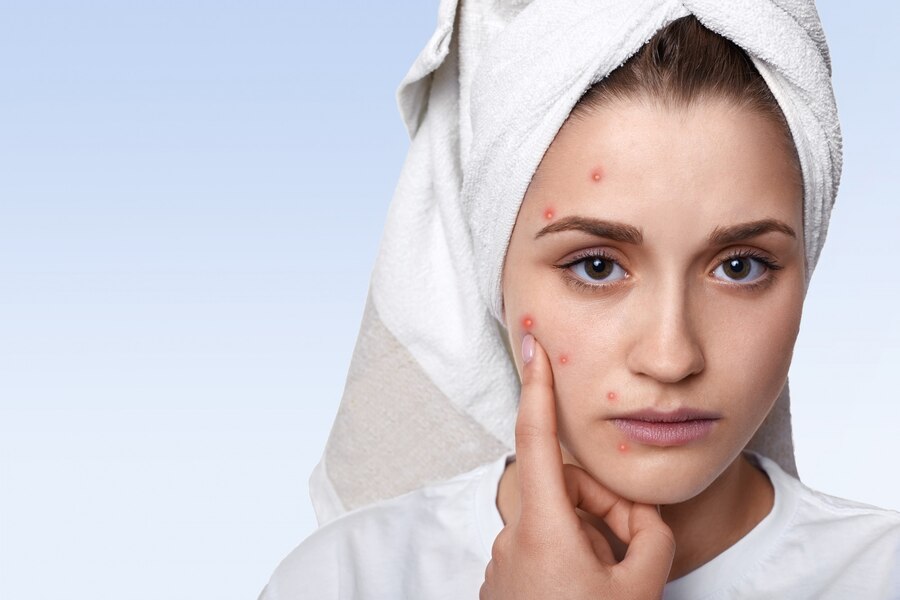 Using CBD Oil Internally for Skin Issues