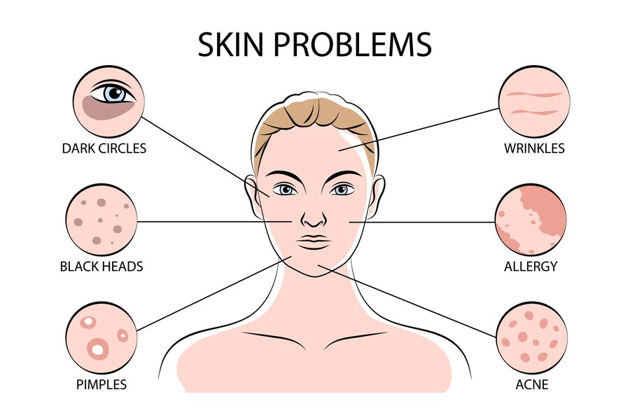 CBD for Skin Conditions: Acne, Eczema, and Psoriasis