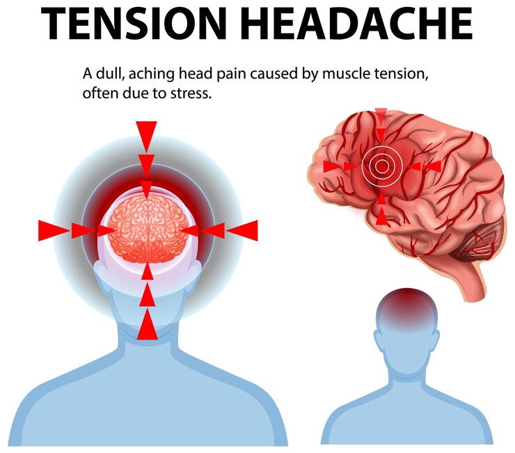Effective Ways to Use CBD for Headaches