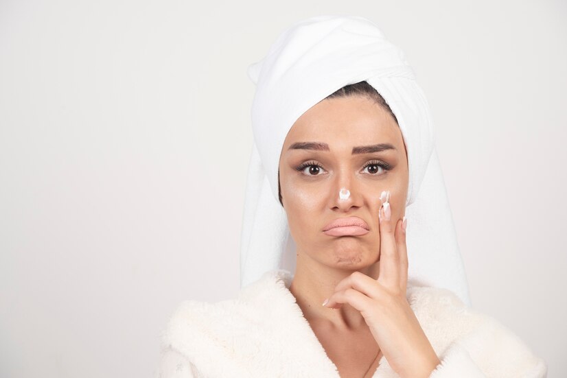My Experience Using CBD for Acne Treatment